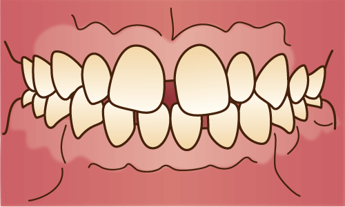 すきっぱ（空隙歯列）